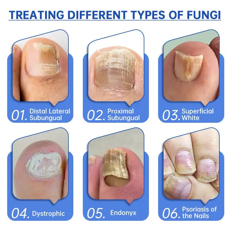 Fungus Laser Therapy Device - Galaxy Cart